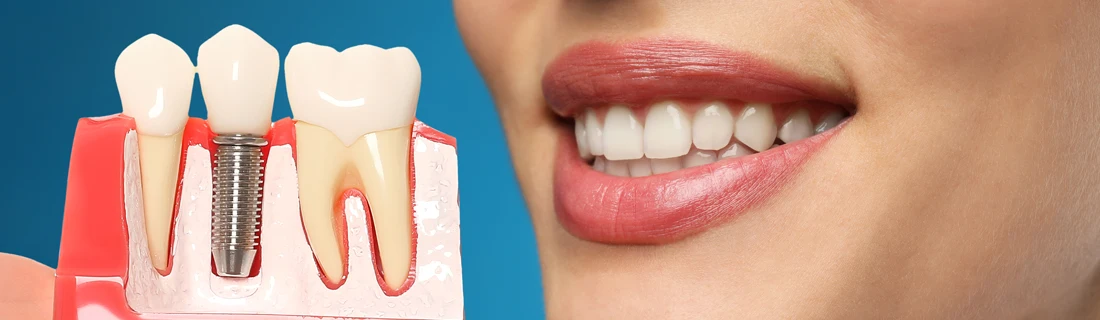 A person smiling next to a model of a mouth with a dental implant.