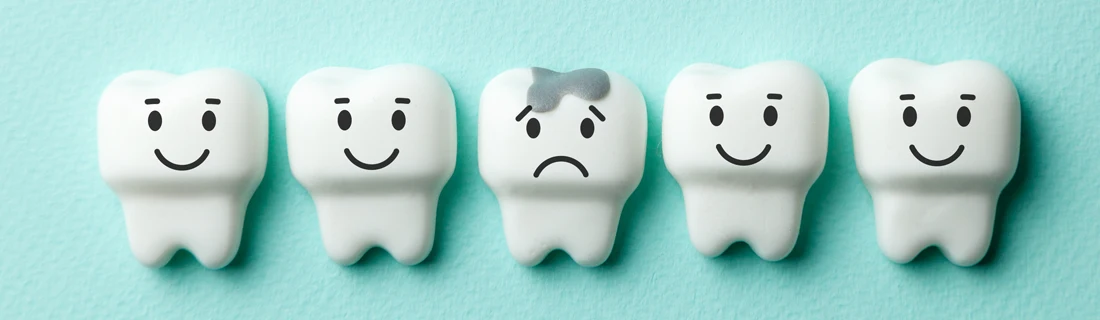 Five cartoon teeth. One has a grey spot on it, to indicate a cavity.